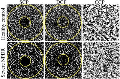 Correlation between vessel density and thickness in the retina and choroid of severe non-proliferative diabetic retinopathy patients